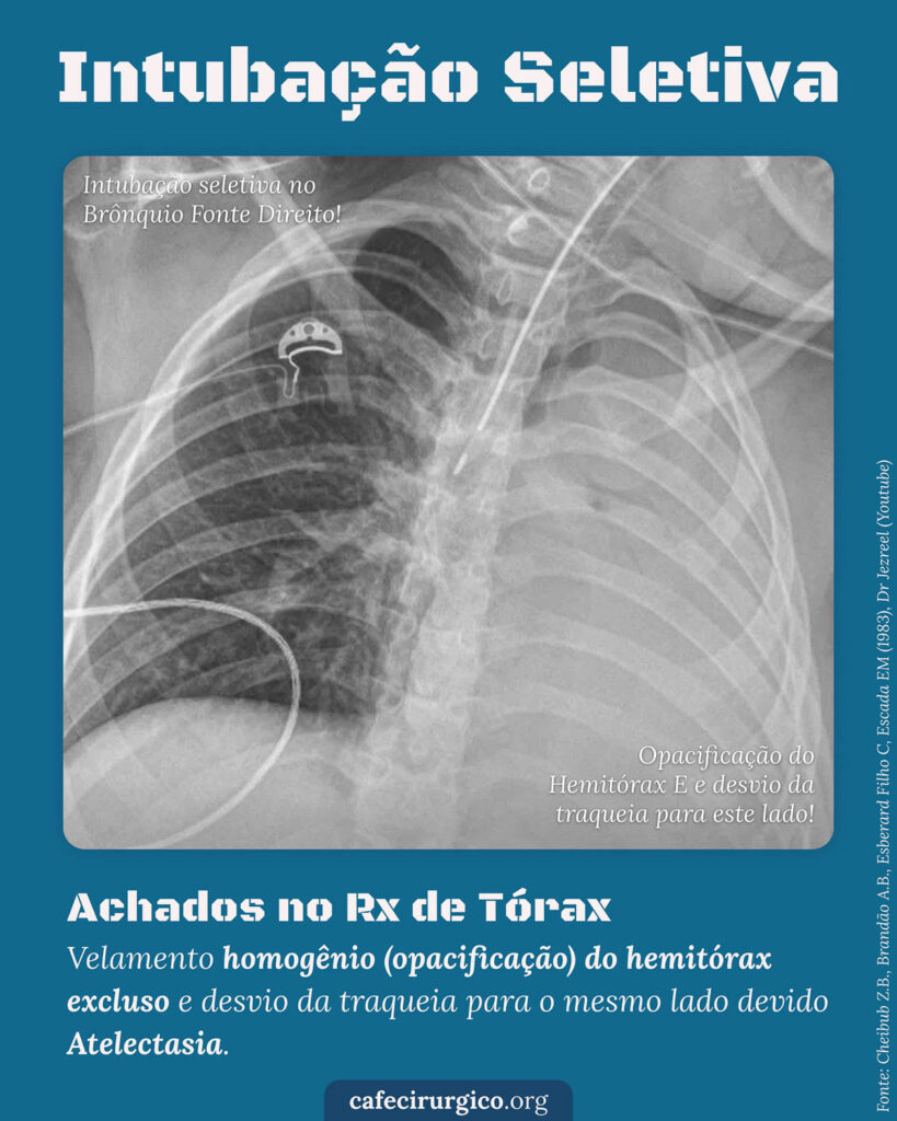 Intuba O Seletiva Como Identificar Caf Cir Rgico