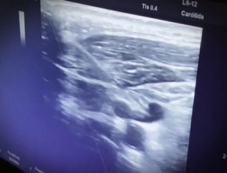 Onde e como passar um Cateter Venoso Central?