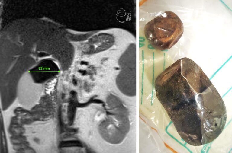 Colelitiase: Um grande cálculo na Vesícula Biliar