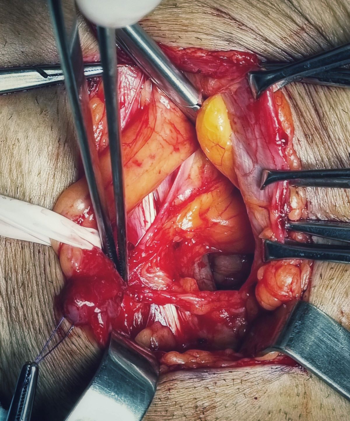 Fiz cirurgia de hérnia inguinal e umbilical quanto tempo depois eu