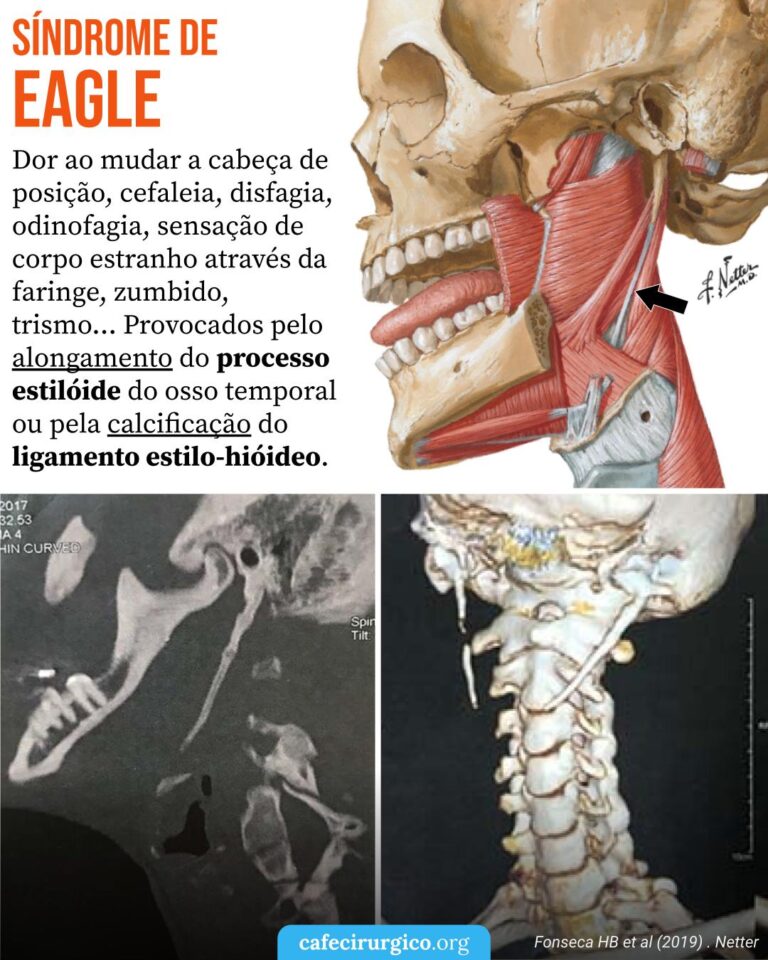 O que é a Síndrome de Eagle
