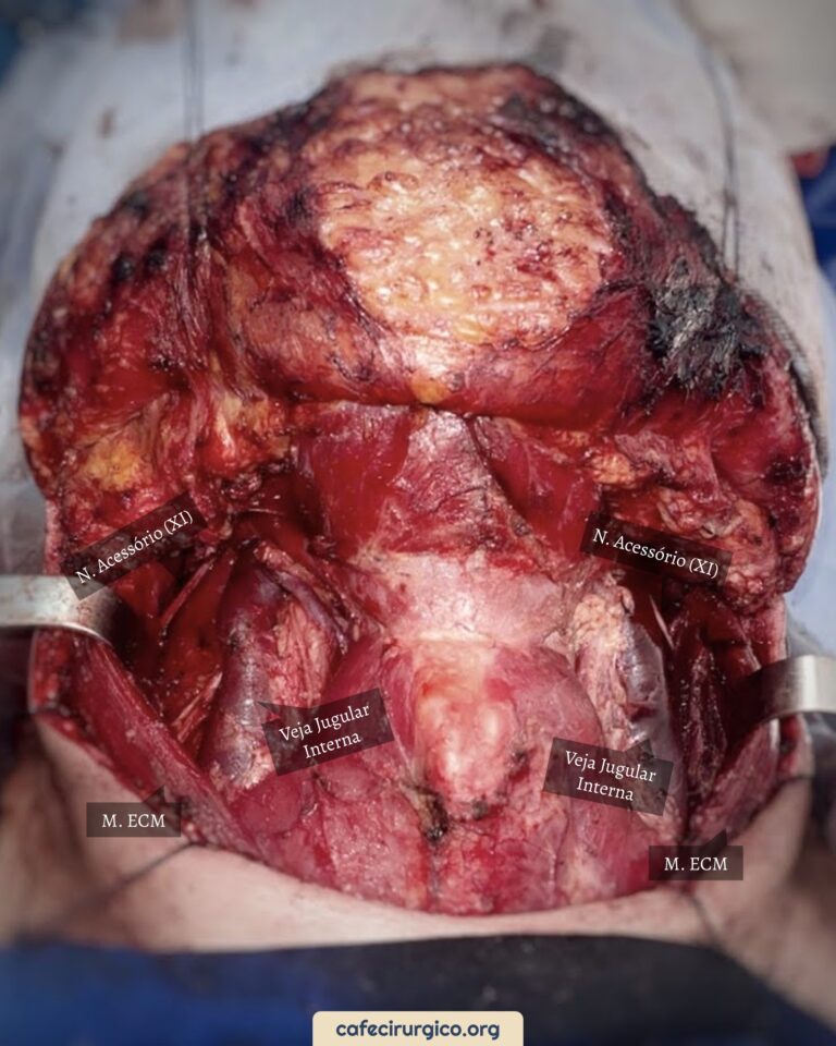 Esvaziamento Cervical Radical Modificado Tipo III Bilateral